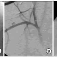 Fig. 2. A y B. Angiografia a través del introductor, se visualizan las 2 marcas del balón a punto de dilatar la arteria carótida y su ostium. C. Balón insuflado en una posición superior.