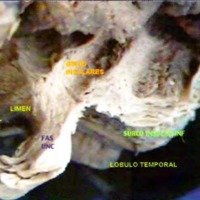 Fig. 5. Convergencia de las fibras longitudinales de los gyrus insulares hacia el limen de la ínsula. Las fibras están destinadas a rodear al fascículo unciforme para acceder a la amígdala por debajo y detrás de él.