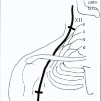 Fig. 7. Neurotización del musculocutáneo con hipogloso. XII: nervio hipogloso, I: injerto, MC: musculocutáneo.
