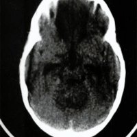 Fig. 3. TAC sin contraste: lesión isodensa y homogénea que ocupa el IV ventrículo con hidrocefalia supratentorial.