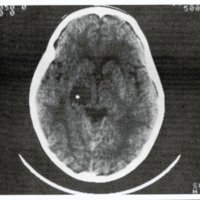 Figura 3. Paciente (le 3 años con Astrocitoma Pilocitico G 1 de Tálamo derecho. Se observa la bolita de Titanio en el interior del tumor (Target).