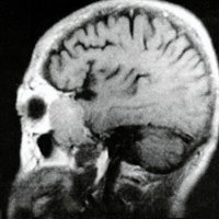 Fig. 2. IRM sagital que muestra una masa intra-extraorbitaria