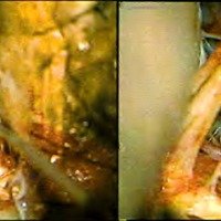 Fig. 3. Paciente en decúbito lateral izquierdo. A través de los pares bajos que ingresan en el agujero rasgado posterior, se objetiva la visión pre (extremo del neuroestimulador en la mano derecha) y postclipado de aneurisma vertebro-PICA derecho.