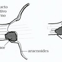 Fig. 4. Patrón de crecimiento tumoral respetando piano aracnoideo (tomado de Yasagil, G)