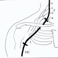Fig. 2. Neurotización del musculocutáneo con frénico, F: nervio frénico, 1: injerto, MC: musculocutáneo.