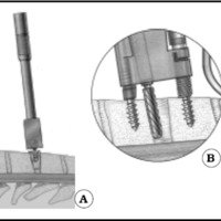 Fig.3. A. Dibujo que muestra la cuña con superficie dentada. B. Dibujo que muestra el fresado paralelo a los platillos vertebrales. C. Radioscopia que muestra la guía de alineación. D. Dibujo que muestra el estabilizador manual durante el fresado de la concavidad.