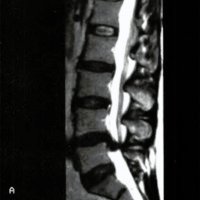 IRM que Simularon una Hernia de Disco Lumbar: Características Quirúrgicas