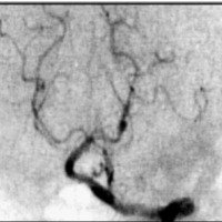Fig. 2. Angiografía diagnostica que muestra aneurisma en arteria cerebral posterior, segmento P2.