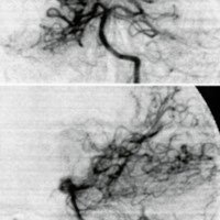 Fig. 7: Control angiográfico postoperatorio sin MAV residual