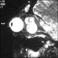 Fig. 3. IRM en T2. Corte sagital donde ser observan múltiples neurofibromas