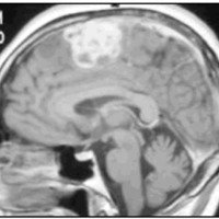 Fig. 2. IRM corte sagital T1 con contraste evidenciando lesión tumoral en AMS izquierda