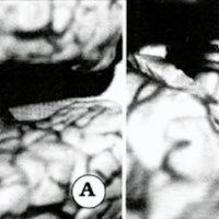 Fig 4. Reproducción cadavérica del abordaje. A. Se ha efectuado una corticotomía en el lóbulo cuadrilátero y una callostomia posterior para ingresar al ventrículo. Nótese que el lado de la lesión queda hacia abajo. 1: cuerpo calloso; 2: fimbria; 3: tálamo. B. A mayor aumento se ve la callosotomía (1) y por delante de lo fimbria (2), el tálamo (3) y el plexo coroideo (4). Si es posible se preserva el cíngulo medialmente.