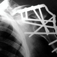 Figura 1B: Artrodesis de hombro, radiografía frente.