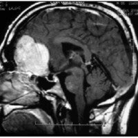 Fig. 1. IRM de encéfalo con gadolinio en cortes sagitales de paciente con un meningioma del surco olfatorio.