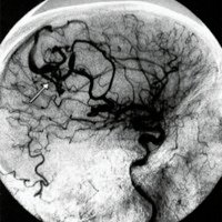 Fig. 2. Angiografia preoperatoria. FAV cortical parietal derecha con aferencias silvianas y drenaje único al seno longitudinal superior (flecha).