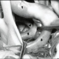 Fig 2. Abordaje transilviano derecho. 1) arteria carótida interna derecha; 2) arteria cerebral media derecha; 3) arteria cerebral anterior derecha; 4) arteria cerebelosa superior izquierda; 5) arteria cerebral posterior izquierda.<br />
