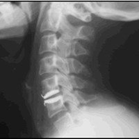 Fig. 1. Radiografía simple de perfil que muestra en el caso 1 la alineación sagital del implante en C5-C6.