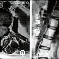 Fig. 4. A y B, IRM preoperatoria. C y D, IRM postoperatoria, mostrando exéresis parcial del tumor.