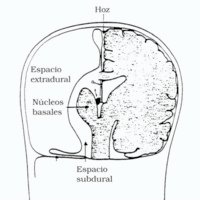 Hemisferotomia Como Tratamiento de Encefalitis de Rasmussen