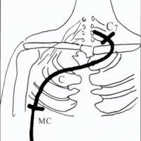 Fig. 6. Neurotización del musculocutáneo con raíz C7 contralateral, C: cubital, actuando como injerto pediculado, MC: musculocutáneo.