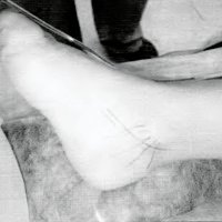 Fig. 4. Cara interna del pie derecho, con incisión marcada para descomprimir el nervio tibial posterior.