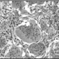 Fig. 4: Visión microscópica a 100 x de un tumor de células gigantes.