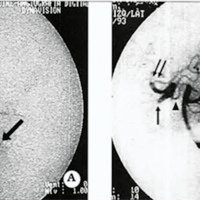 Fig 3. Angiografía Digital de FCC postraumática con fenómeno de "robo" hemodinárnico completo sobre la circulación hemisférica. 