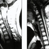 Fig. 2 A. Otro caso, IRM T1 con contraste. Porción quística superior. B. Exéresis total del tumor.