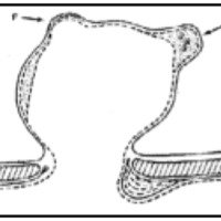 Fig. 8. Diferentes formas de loculación del aneurisma según Crompton54. Un lóculo secundario puede formarse por degeneración fibinoide (F) o por degeneración aterosclerótica (A). Obsérvese el engrosamiento intimal del vaso portador a nivel de la entrada al aneurisma. Ëste es un fenómeno de la parte proximal de la boca del cuello, por lo que probablemente el flujo sea hacia la izquierda.