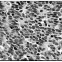 Fig. 1. Células pluripotenciales pequeñas, con tendencia aformar rosetas. Roseta de Homer Wright.