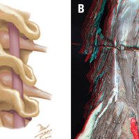 Anatomía quirúrgica en 3D de las osteotomías vertebrales cervicales<br /><br />
Premio AANC para Global Spine