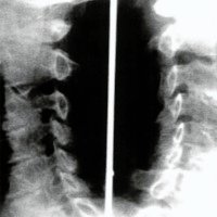 Fig. 9. Caso clínico 1. Rx simple: estenosis de los agujeros de conjunción por discartrosis