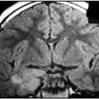 Fig 2. IRM. T1. Proyección coronal: se observa lesión mesial y neocortical derecha.