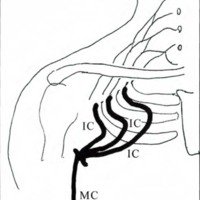 Fig. 4. Neurotización del musculocutáneo con intercosta les. IC: intercostales, MC: musculocutáneo