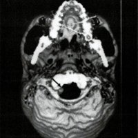 Fig. 2: Reconstrucción tridimensional que evidencia desplazamiento medial del cóndilo fracturado (flecha).