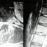 Fig 1. IRM axial (A) y sagital (B) que muestran una hernia de disco dorsal