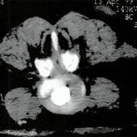 Fig. 5. Paciente GS. No se ve lesión en el anillo fibroso, No hubo dolor durante la inyección del contraste.