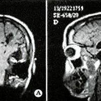 Fig. 3. A. MRI: coronal view showing temporal lobe emptying, as well as central area resection. B. MRI: sagittal view corresponding to the same patient.
