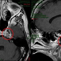 Figura 2: RMI Cerebral: muestra la una lesión expansiva retrocarotidea izquierda a nivel del ápex petroso.