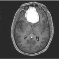 Fig 3. IRM preoperatoria con contraste