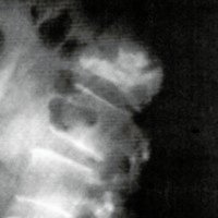 Fig. 7. Vertebroplastia completada. Incidencia lateral. Nivel T12 (fractura osteoporótica)