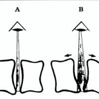 Fig. 1. Esquema sobre la visión del borde posterior de los cuerpos vertebrales a través del interespacio. A) sin distracción. B) con distracción.