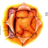 Figura 24. Esquema de craneotomía derecha, que nos muestra el campo quirúrgico (espacio de 2 A 3 cm aproximadamente) entre 2 venas puente que drenan al seno longitudinal superior