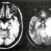 Figura 4 (A): Imagen de glioma temporal izquierdo medido por su T1. (B): Imagen a predominio T2 del mismo caso.	