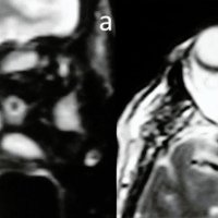 Figura 12: Paciente 2: RMI de cerebro y orbitas en tiempo de relajación T2: a) Corte coronal en T2 que evidencia engrosamiento de los músculos extrínsecos del ojo izquierdo, b) Corte axial muestra la vena oftálmica dilatada y proptosis del globo ocular izquierdo.