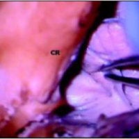 Fig. 23. Vista lateral derecha del tronco y cerebelo luego de resecar la amígdala y abrir los recesos lateral y posterolateral.