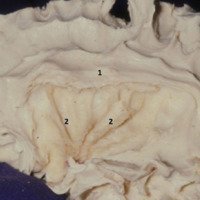 Figura 15: Visión de la cara lateral del hemisferio cerebral izquierdo a través de la disección de fibras blancas por la técnica de Klinger. Fibras en “U” comunicando los giros insulares (2). Fascículo arqueado (1).