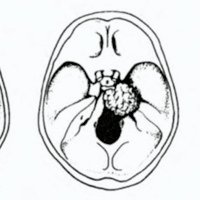 Fig. 1. Esquema que muestra la proyección de los meningiomas petroclivales de acuerdo al tamaño.