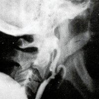 Anastomosis Temporo Silviana. <br /><br />
Indicaciones, Técnica y Resultados (Experiencia Personal)