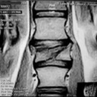 Fig. 2. Fractura estallido vertebral IRM coronal.